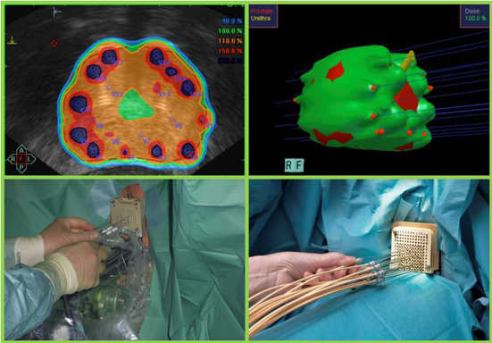 radioterapia cáncer próstata cáncer de próstata tratamiento
