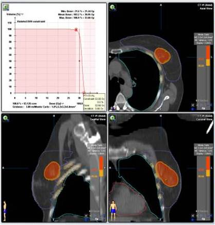 servicio oncología de mama