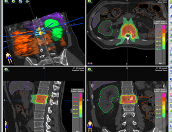 metástasis suprarrenal