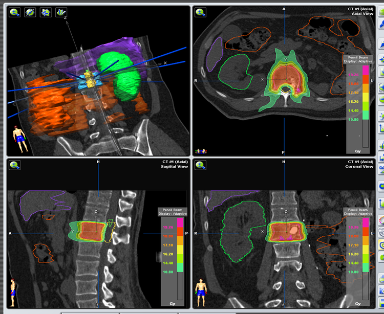tratamiento de metástasis de cáncer de próstata de la columna vertebral tratamiento de metástasis de cáncer de próstata de la columna vertebral