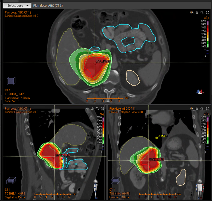 metástasis suprarrenal