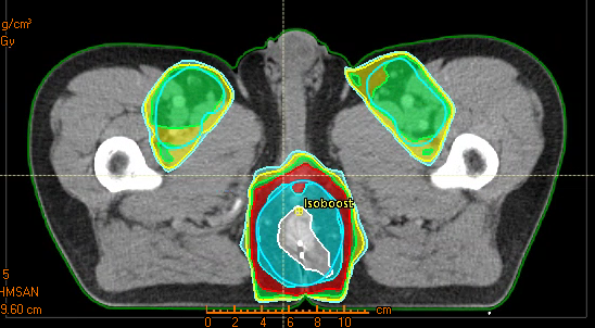 cáncer canal anal