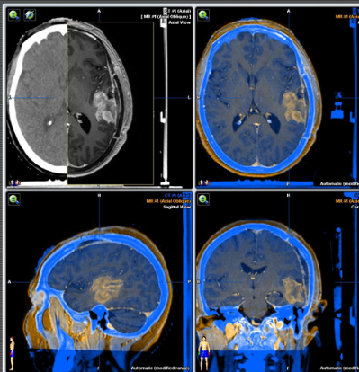 oncología tumores cerebrales
