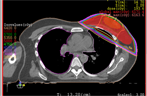 radioterapia para el cáncer de mama