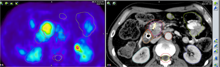 cáncer de pancreas