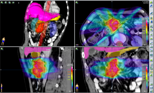 cáncer de pancreas tratamiento