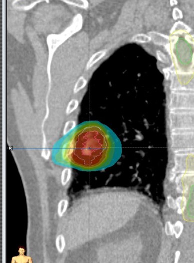 cáncer de pulmón tratamiento