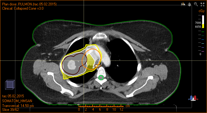 cáncer de pulmón tratamiento