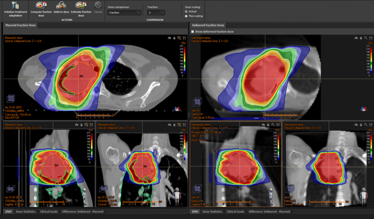 radioterapia en oncología