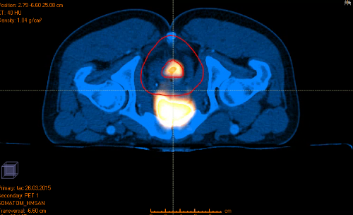 cáncer de recto