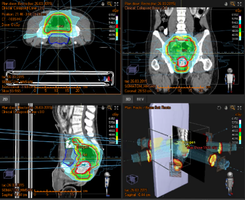 cáncer de esófago y estómago