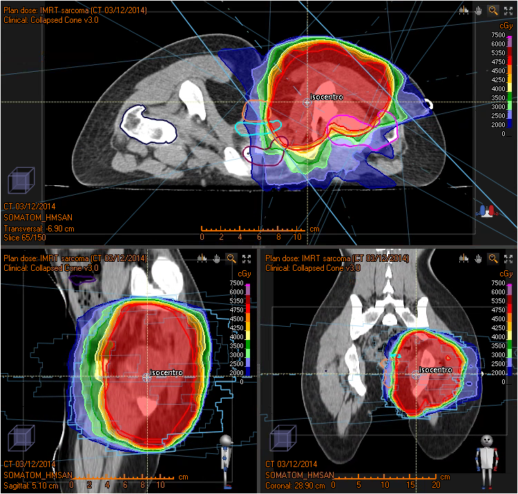 tratamiento sarcomas