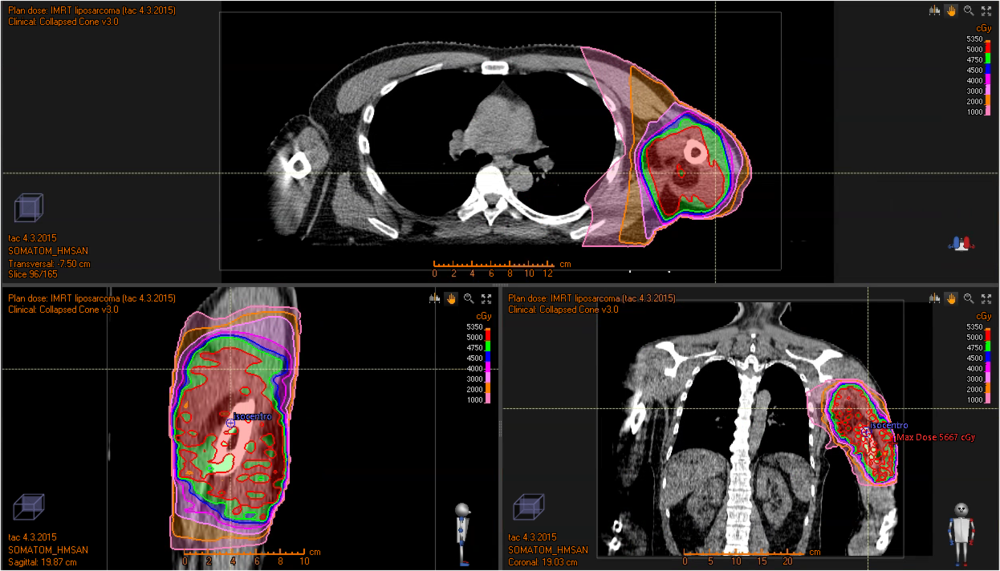 cáncer sarcomas