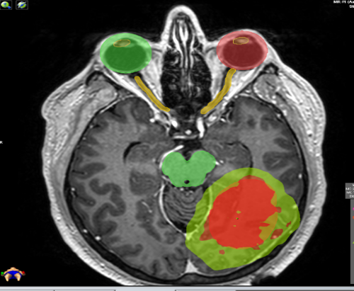 tumores cerebrales radiología