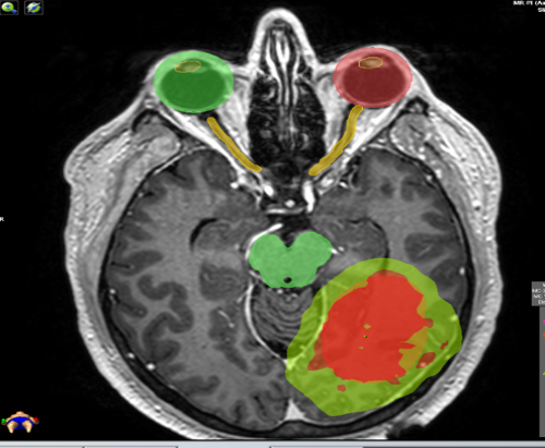 tumores cerebrales cancerígenos