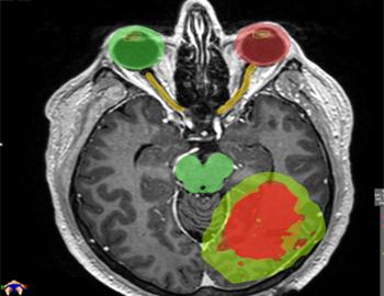 metástasis en el cerebro