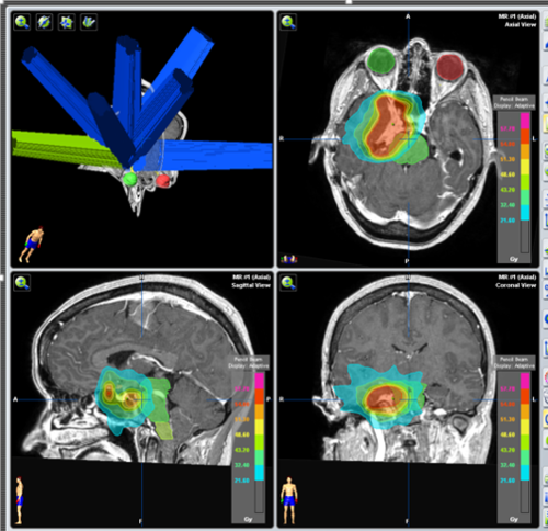 irradiación tumor cerebral